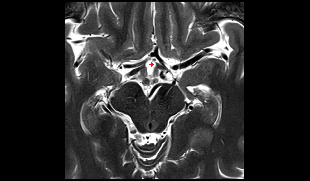 Supraoptic recess mri 3t axial image