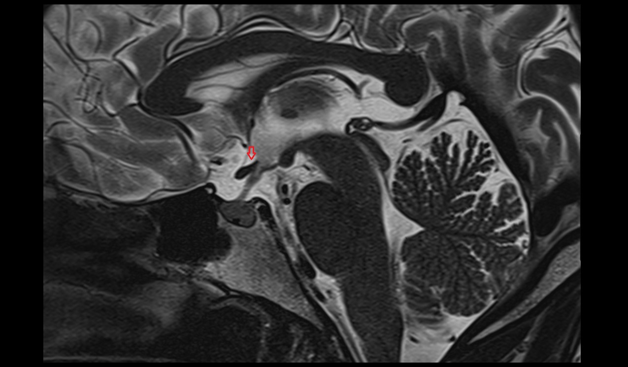 Supraoptic recess mri 3t sagittal image