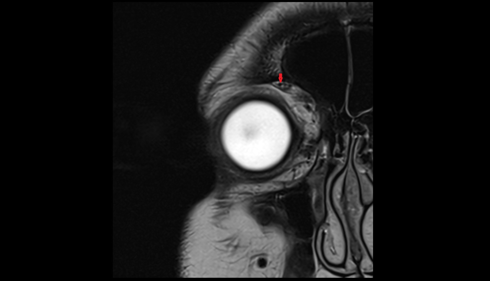 Supraorbital vein mri image