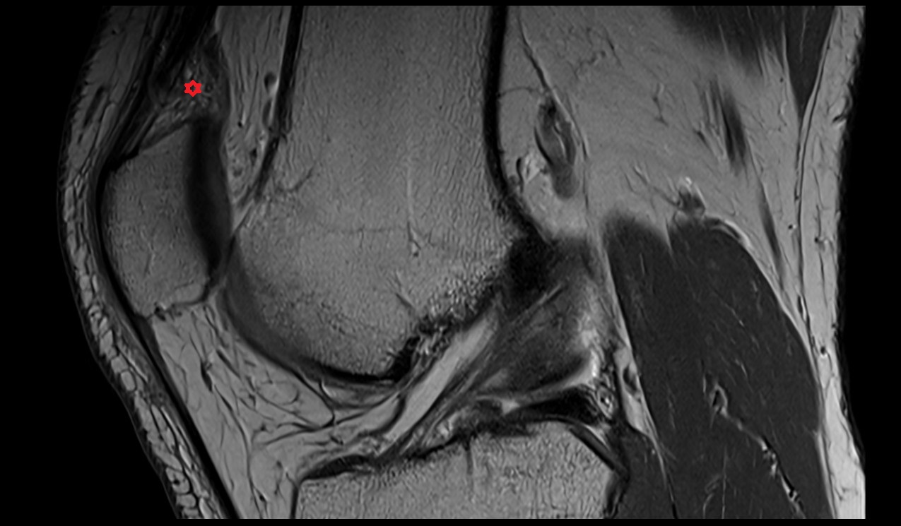Suprapatellar fat pad