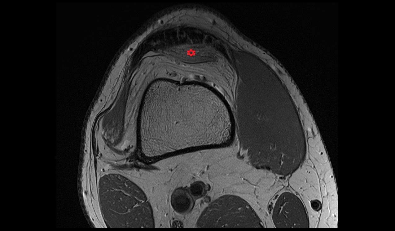 Suprapatellar fat pad anatomy mri 3t image