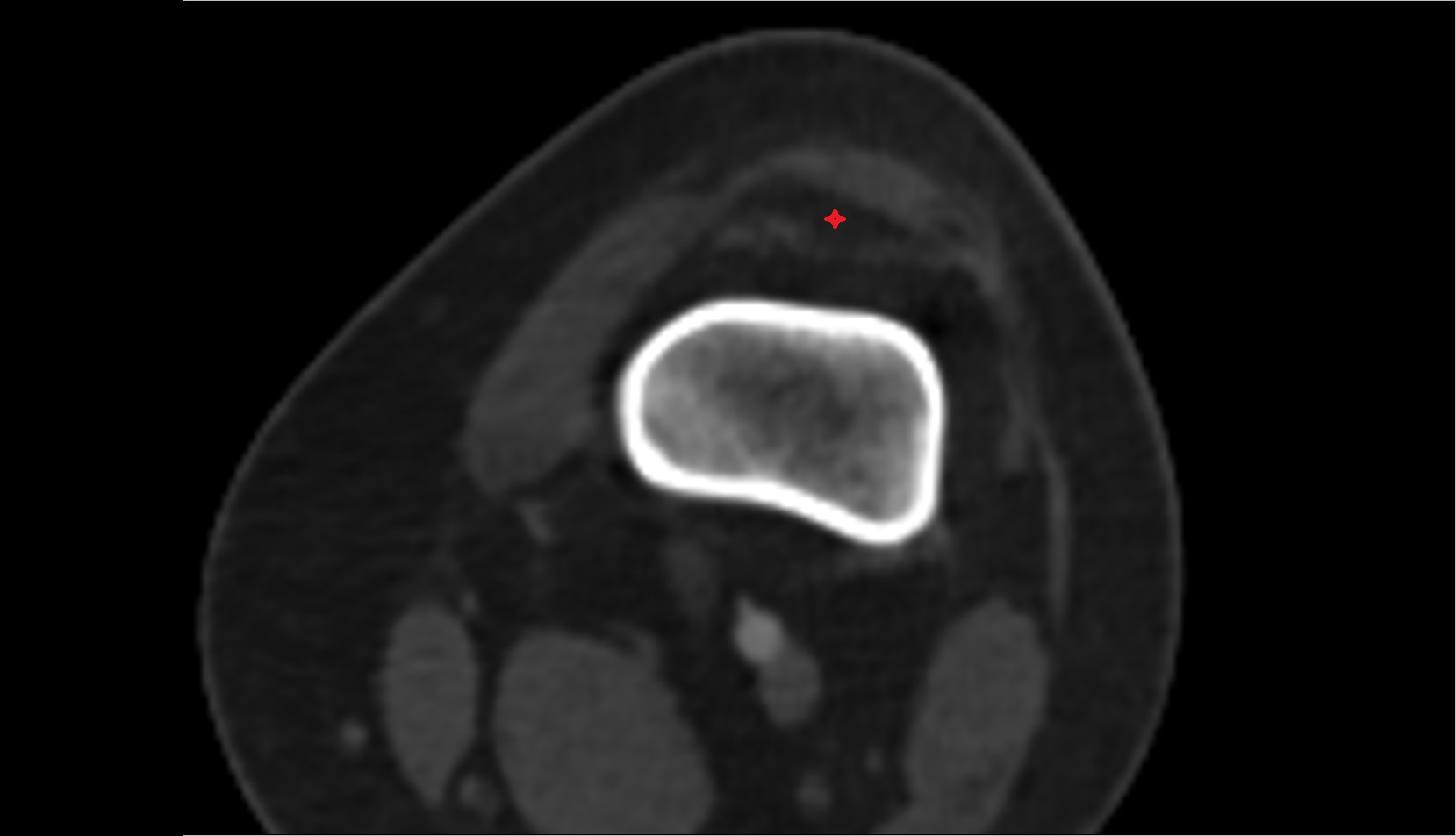 Suprapatellar (quadriceps) fat pad ct image