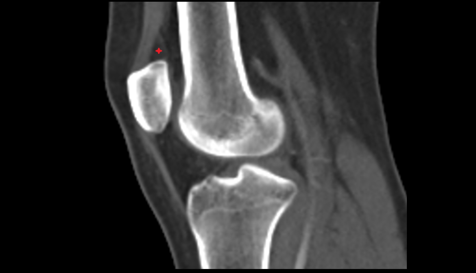Suprapatellar (quadriceps) fat pad ct sag image