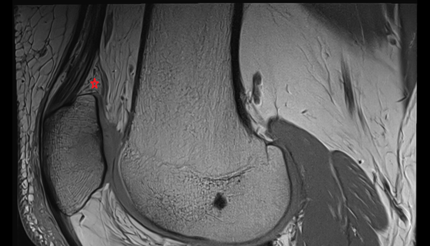 Suprapatellar (quadriceps) fat pad sagittal  cross sectional anatomy 3T MRI AI enhanced  radiology  anatomy image-img-00000-00000