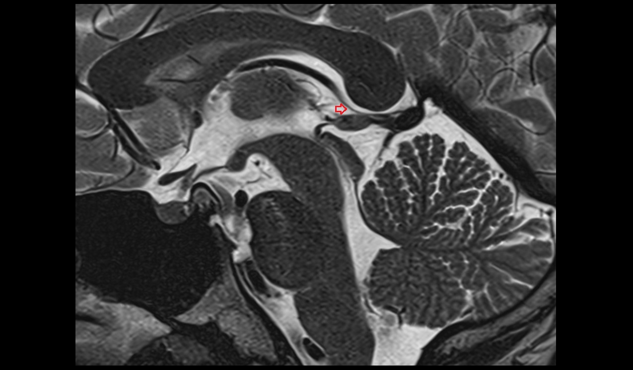 Suprapineal recess mri 3t sagittal image