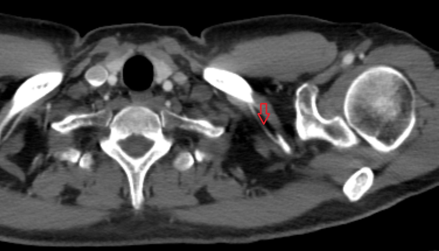 Suprascapular artery  anatomy CT axial  image -img-00000-00000