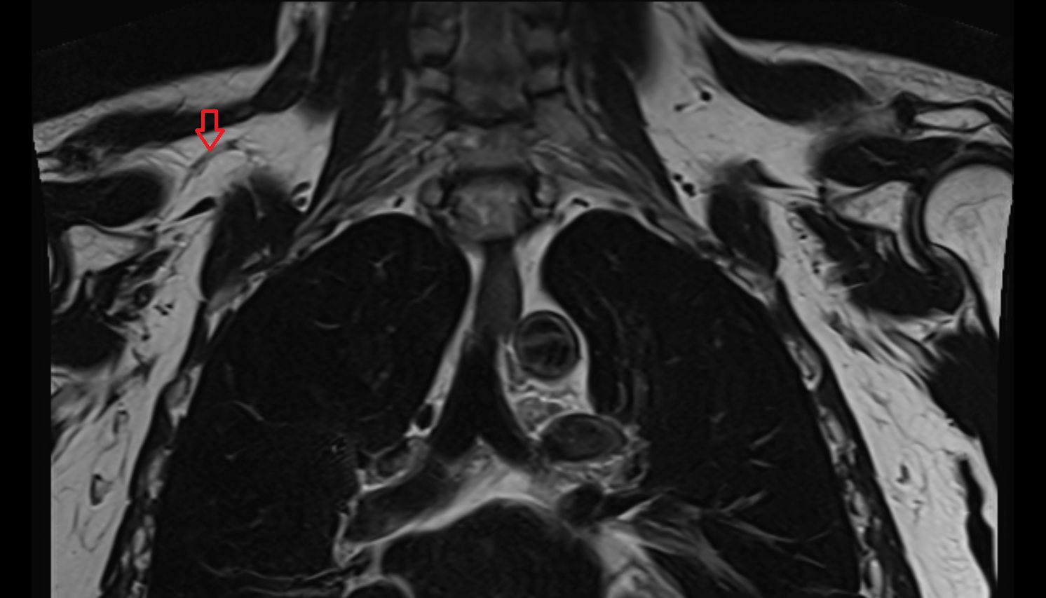 Suprascapular artery  anatomy MRI coronal  image -img-00000-00000