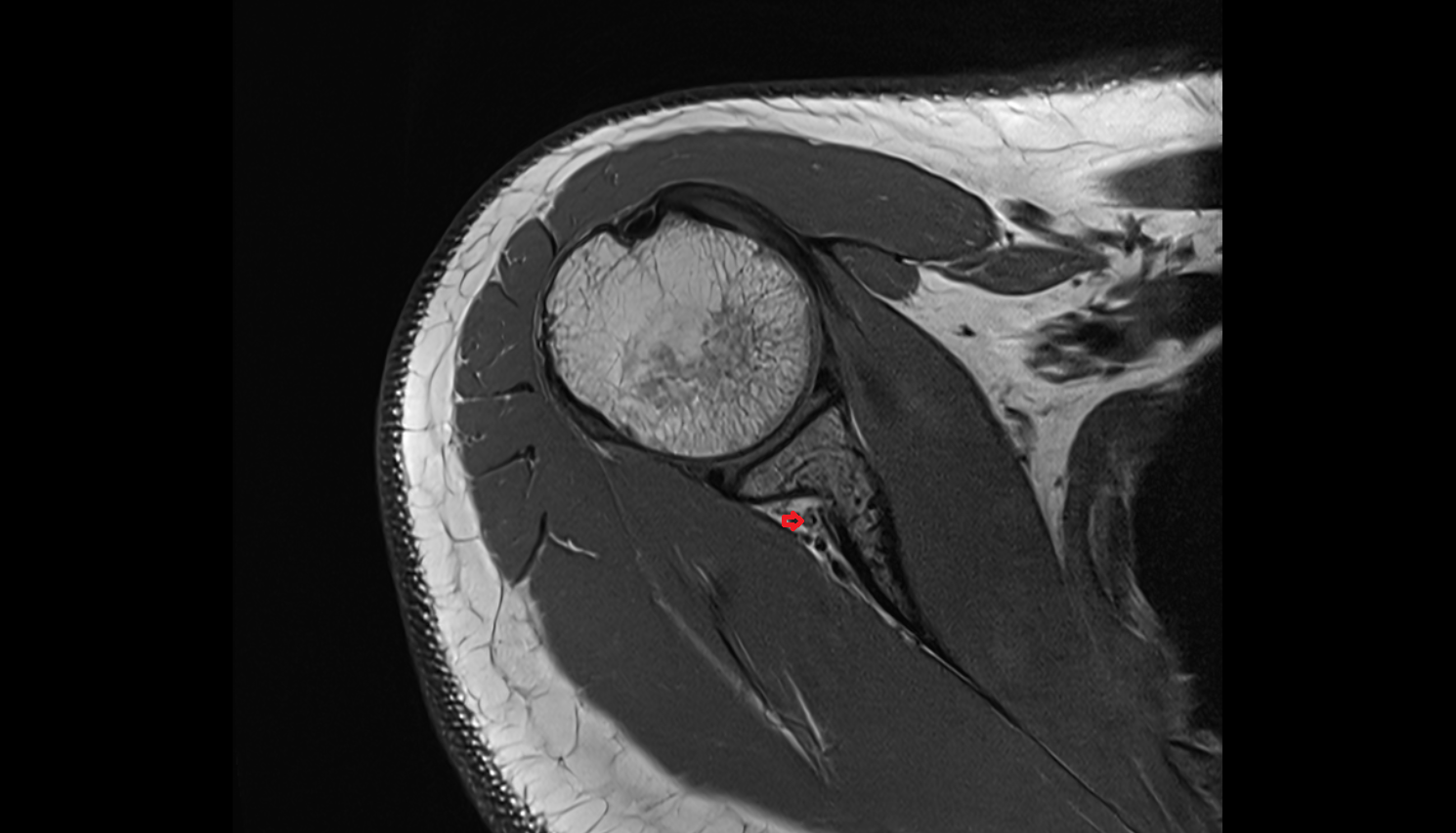 Suprascapular artery  axial cross sectional anatomy 3T MRI AI enhanced radiology image-img-00000-00000