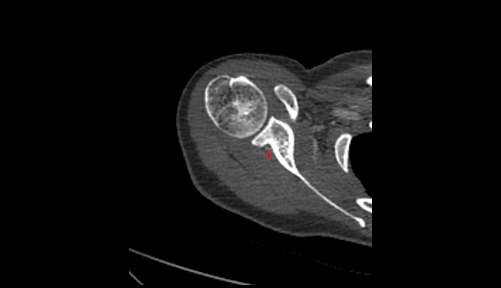 Suprascapular artery ct axial
