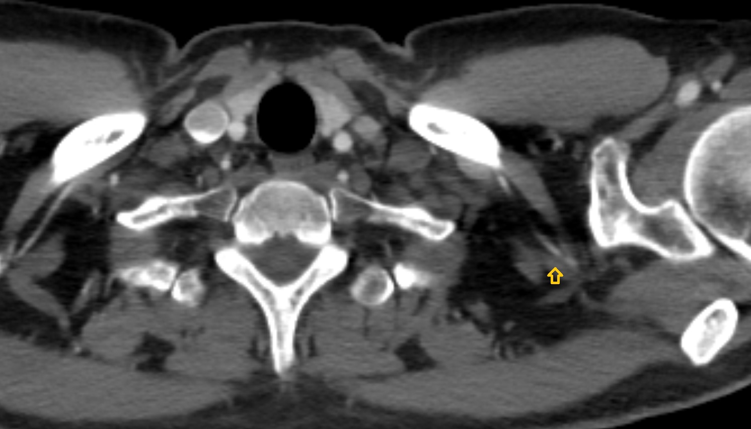Suprascapular vein  CT axial  image -img-00000-00000