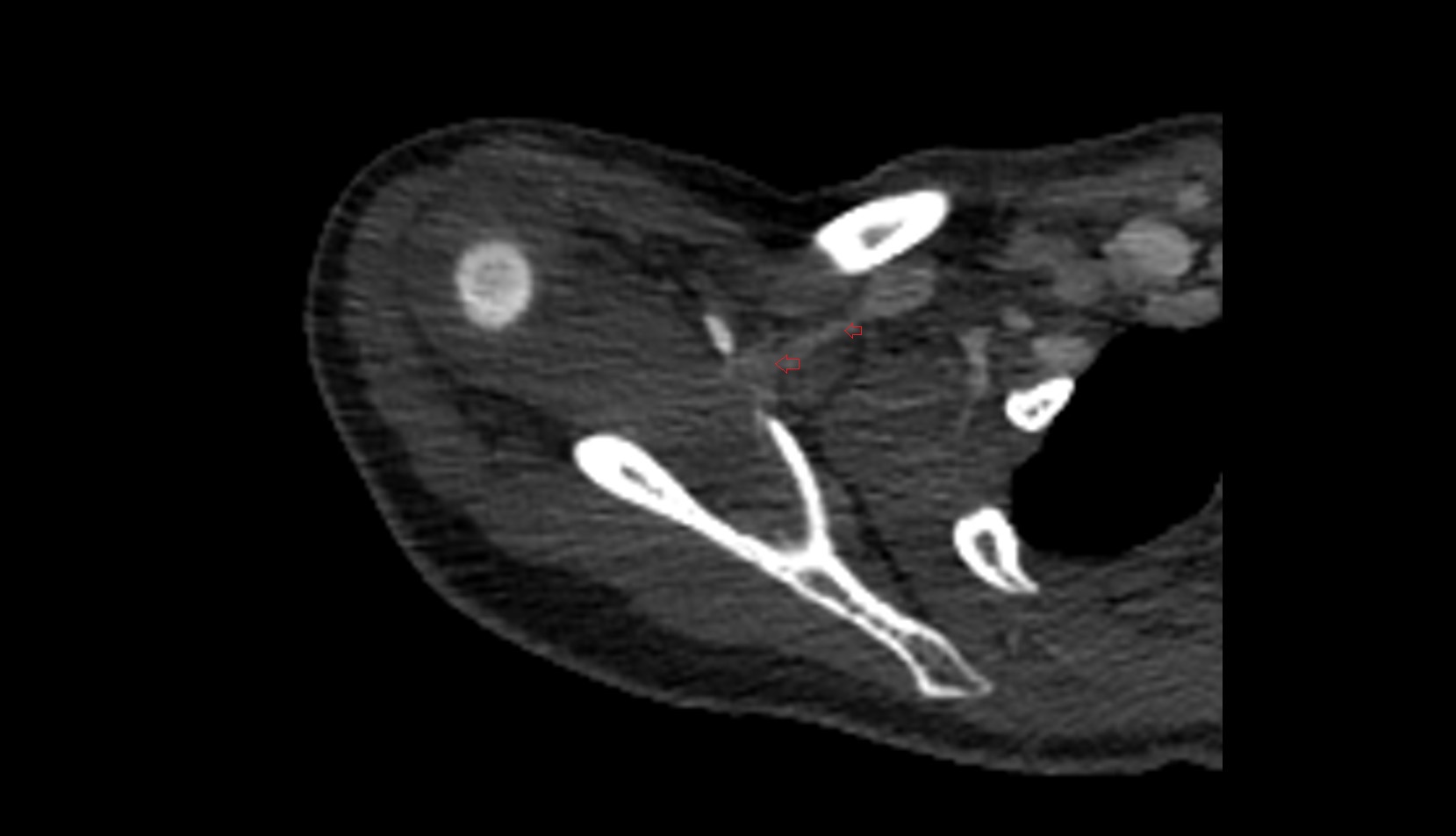 Suprascapular vein ct
