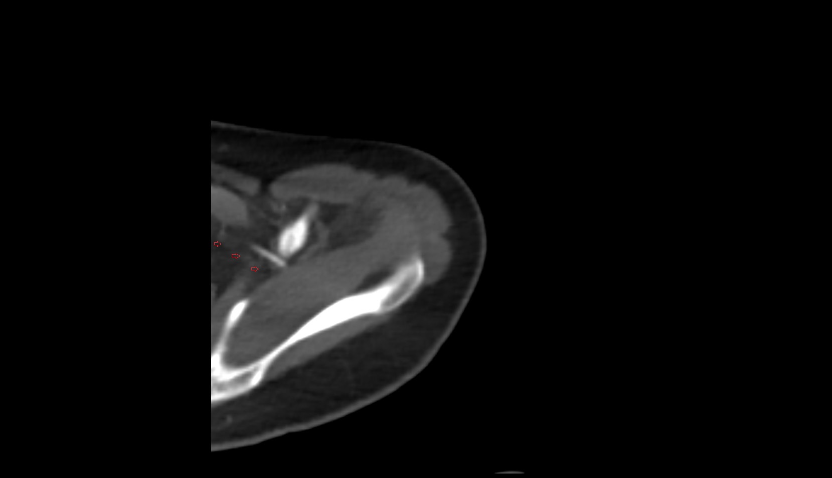 Suprascapular vein ct axial