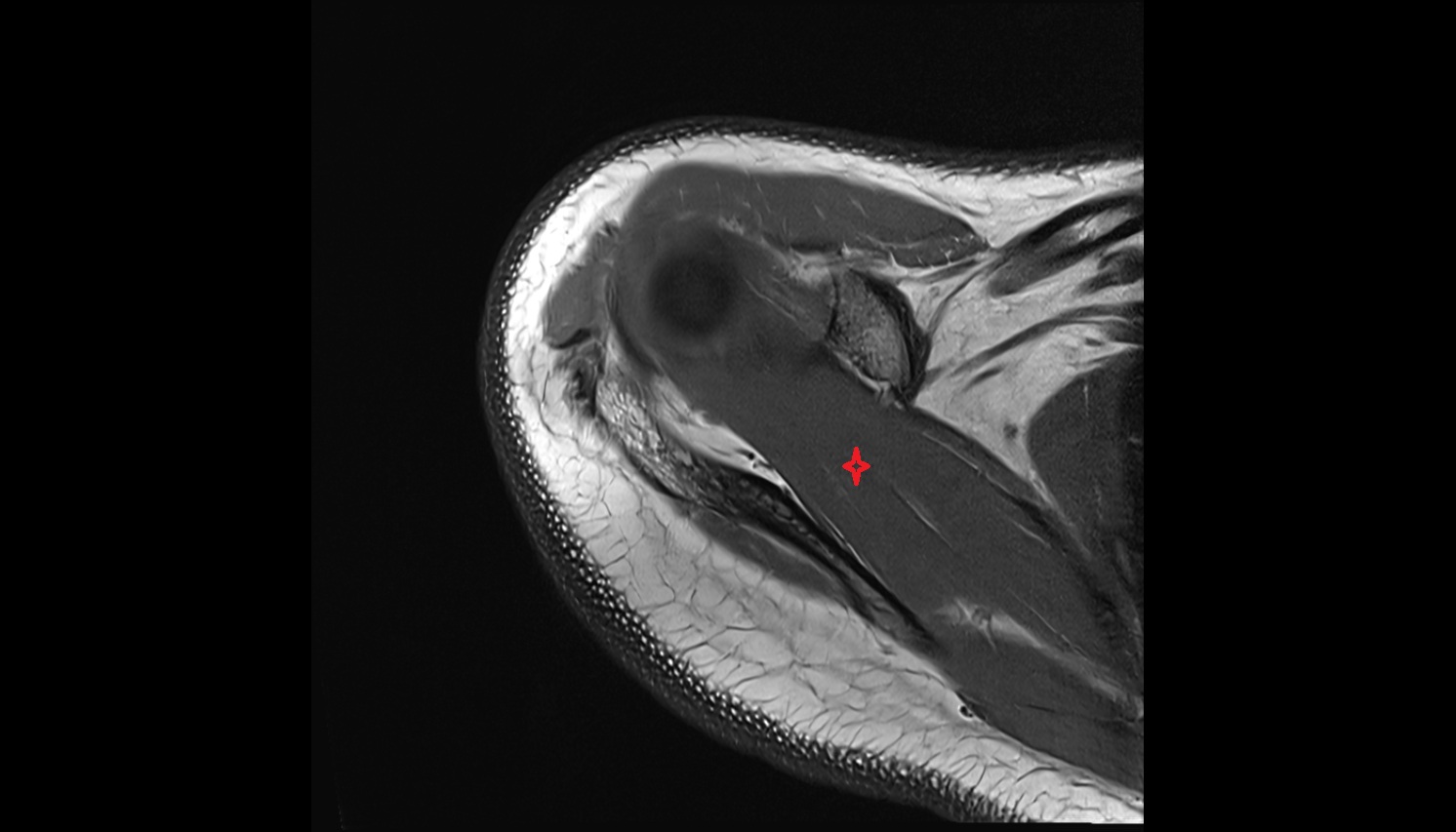 Supraspinatus muscle  anatomy MRI axial  image -img-00000-00000