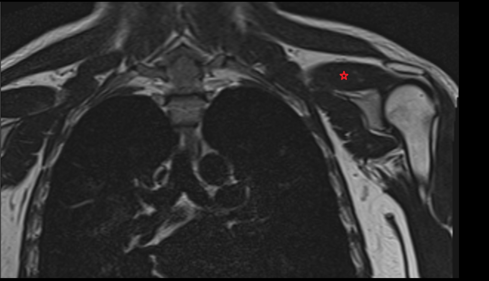 Supraspinatus muscle coronal imaage