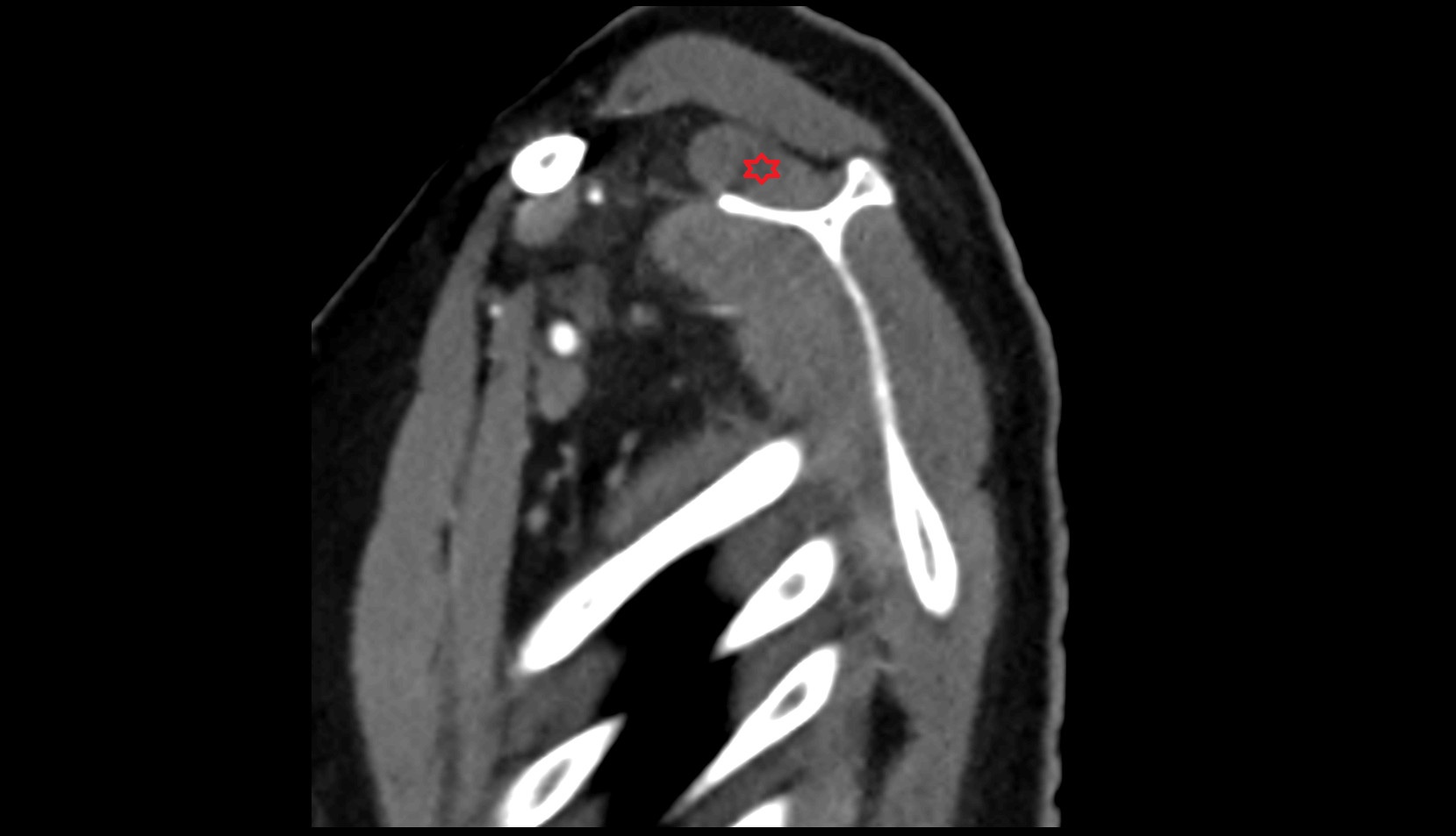 Supraspinatus muscle ct sag image