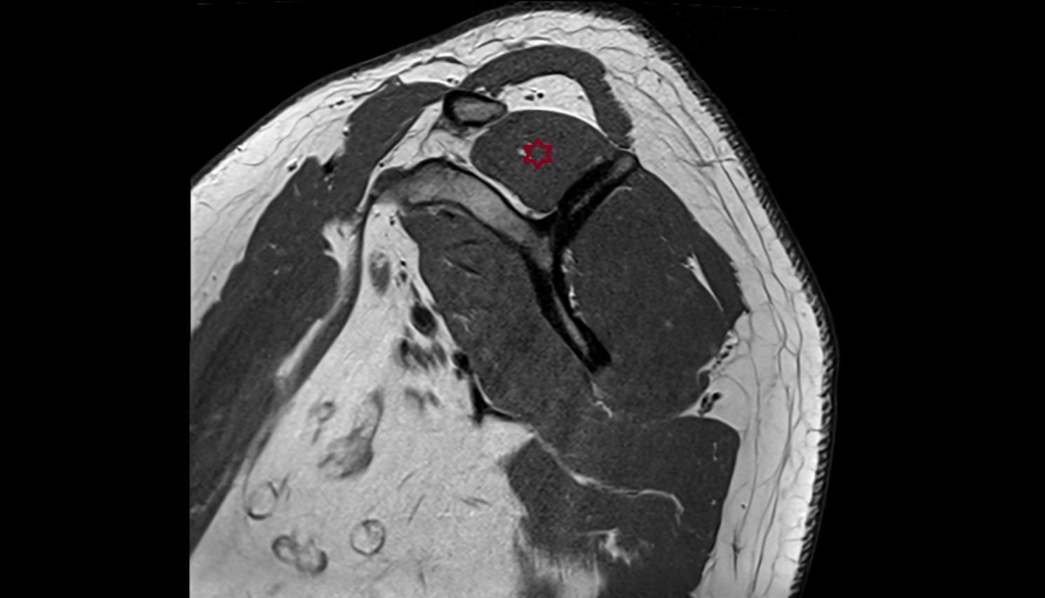 Supraspinatus muscle  sag cross sectional anatomy 3T MRI AI enhanced radiology image-img-00000-00000