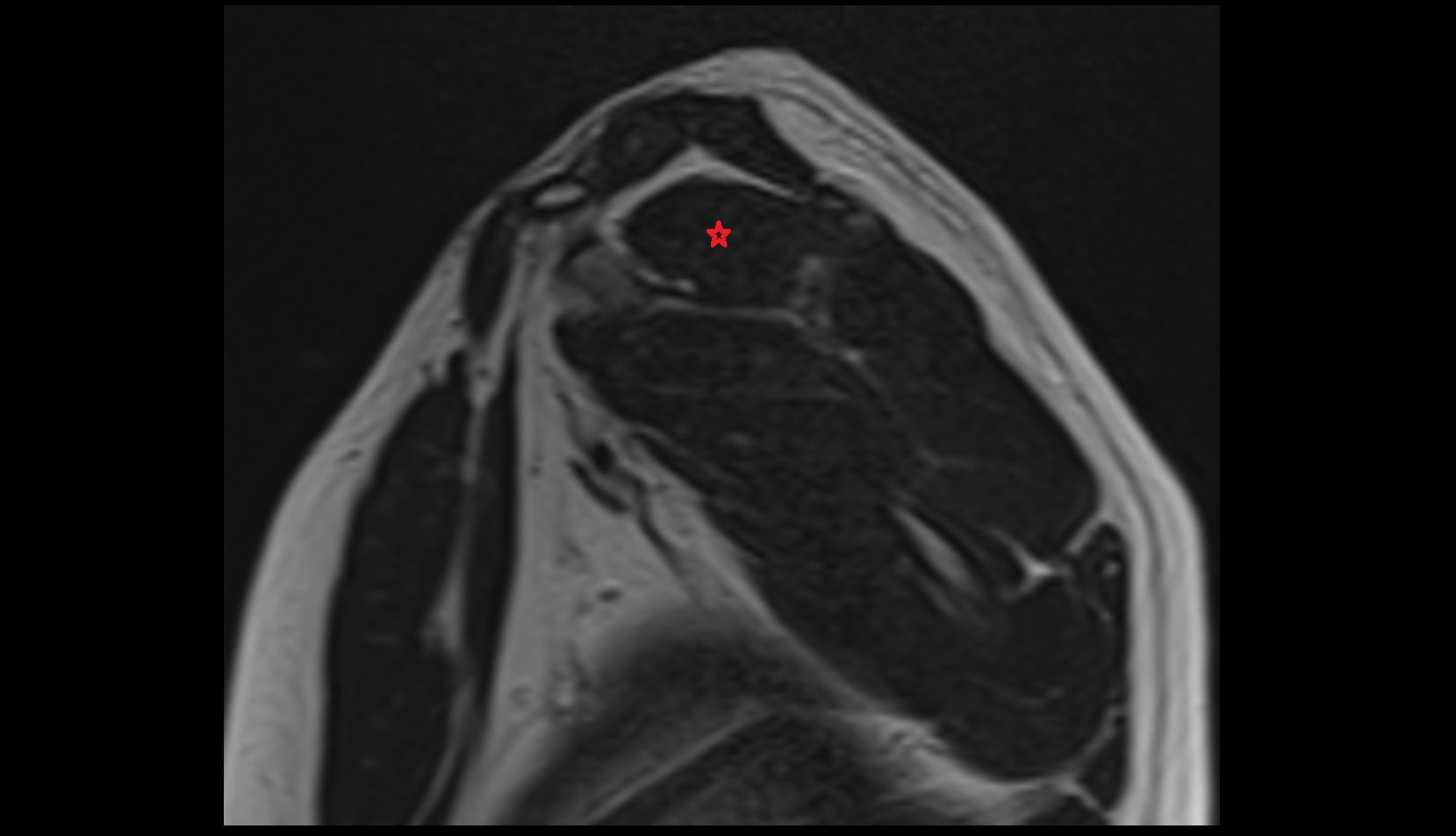 Supraspinatus muscle sagittal mri image