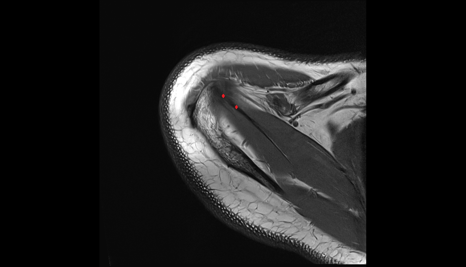 Supraspinatus tendon axial cross sectional anatomy 3T MRI AI enhanced radiology image-img-00000-00000