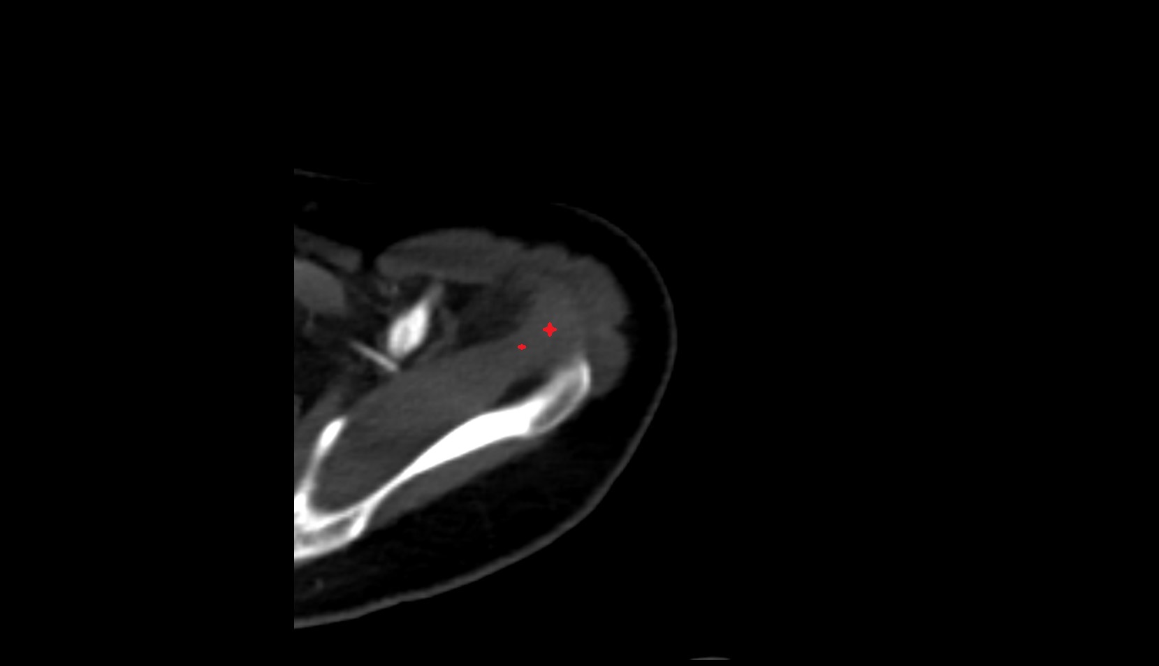 Supraspinatus tendon ct axial