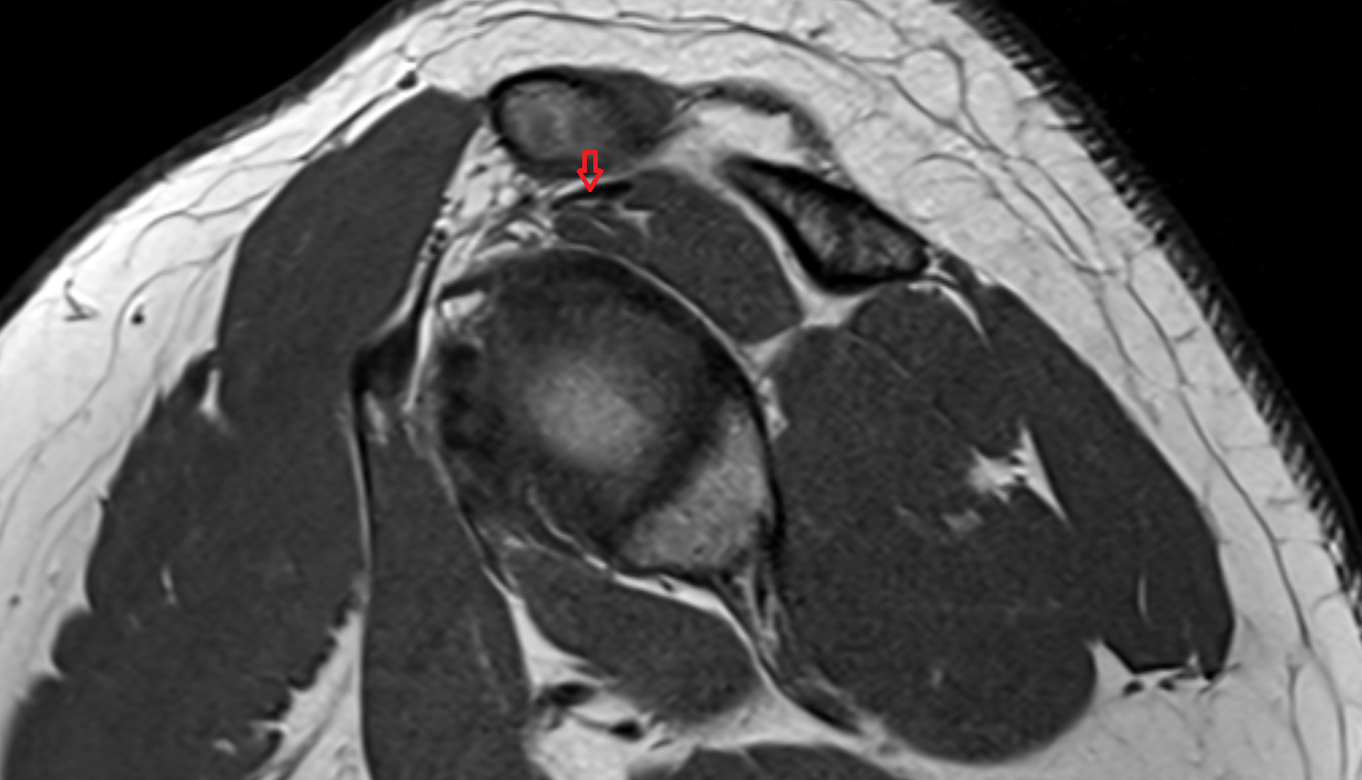 Supraspinatus tendon sag cross sectional anatomy 3T MRI AI enhanced radiology image-img-00000-00000