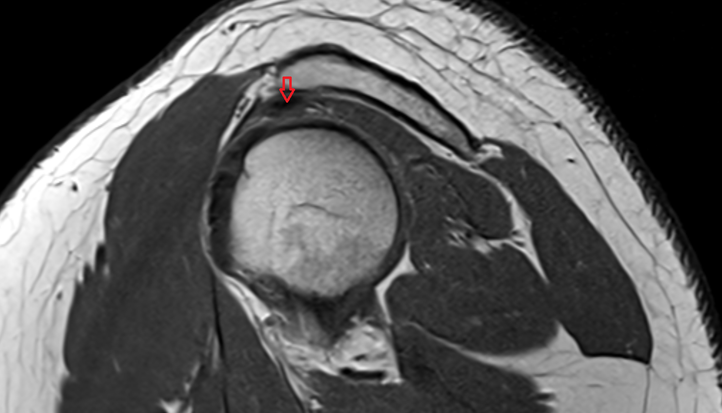Supraspinatus tendon sag cross sectional anatomy 3T MRI AI enhanced radiology image-img-00000-00000_00001