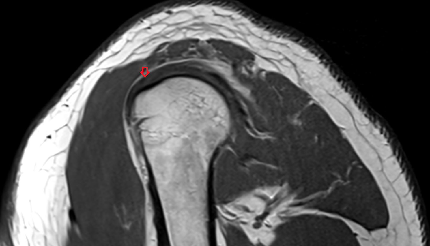 Supraspinatus tendon sag cross sectional anatomy 3T MRI AI enhanced radiology image-img-00000-00000_00002