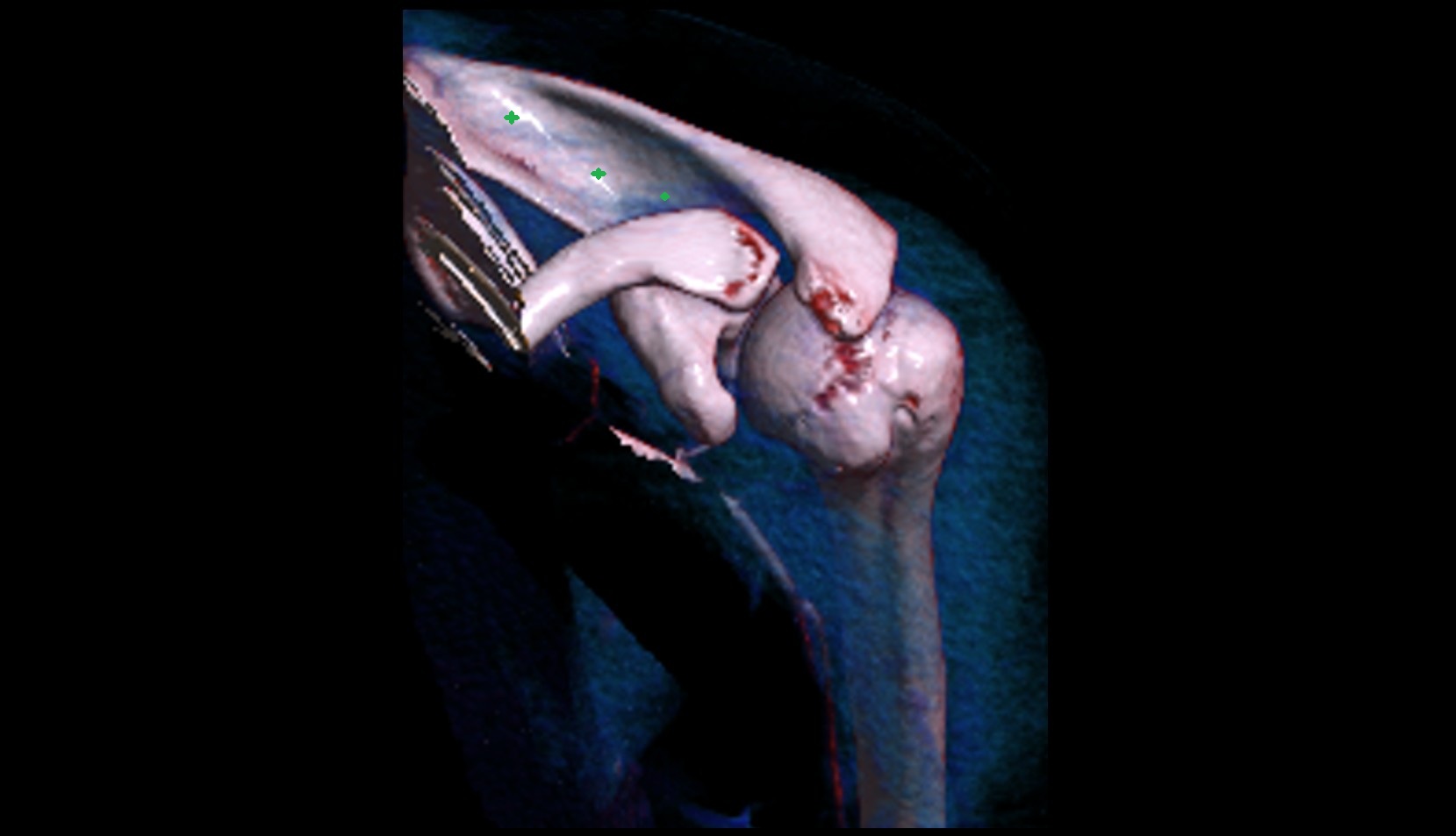 Supraspinous fossa of scapula 3d image