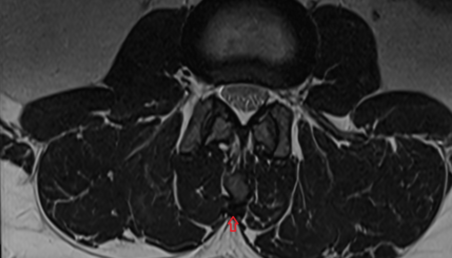 Supraspinous ligament   MRI axial  anatomy  image -img-00000-00000
