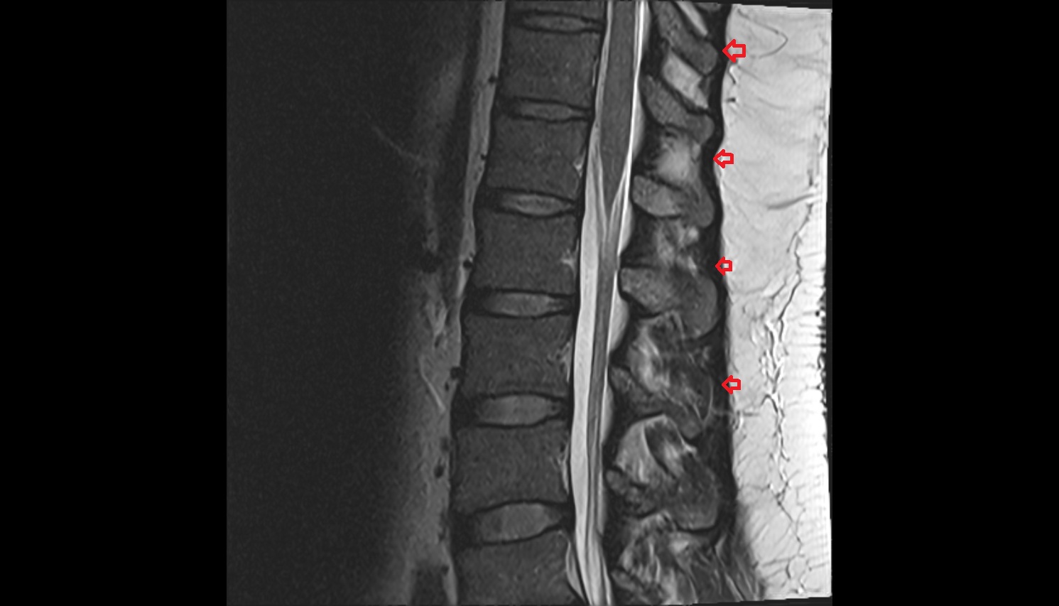 Supraspinous ligament   MRI sagittal  anatomy  image -img-00000-00000