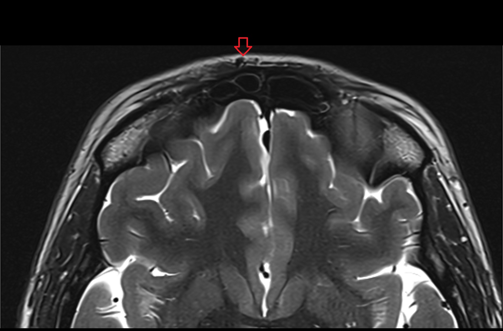 Supratrochlear Veins
