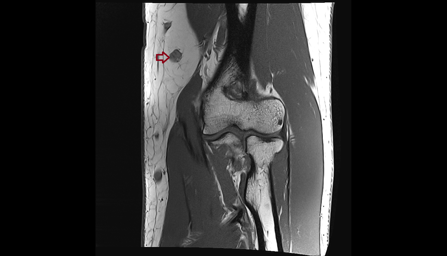 Supratrochlear lymph nodes coronal cross sectional anatomy 3T MRI AI enhanced radiology image -img-00000-00000