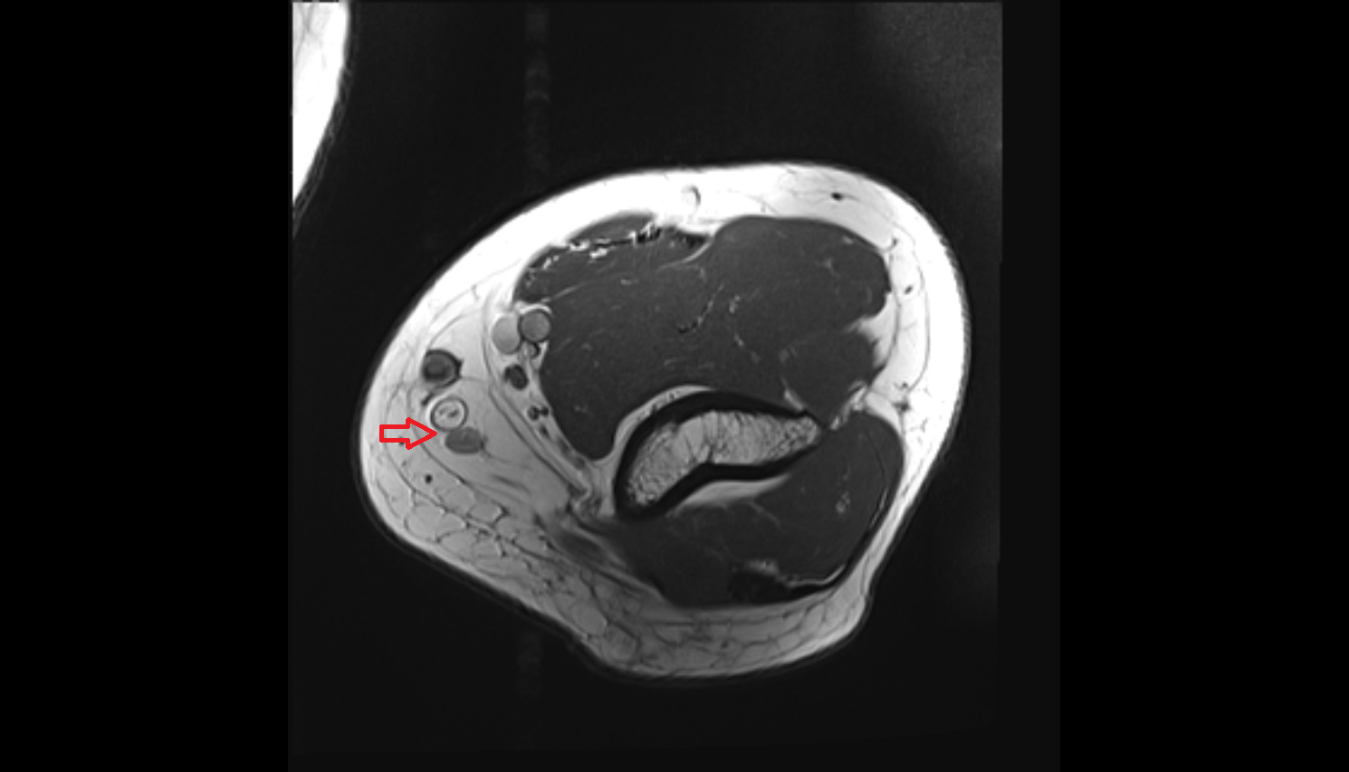 Supratrochlear lymph nodes coronal cross sectional anatomy 3T MRI AI enhanced radiology image -img-00000-00000_00001