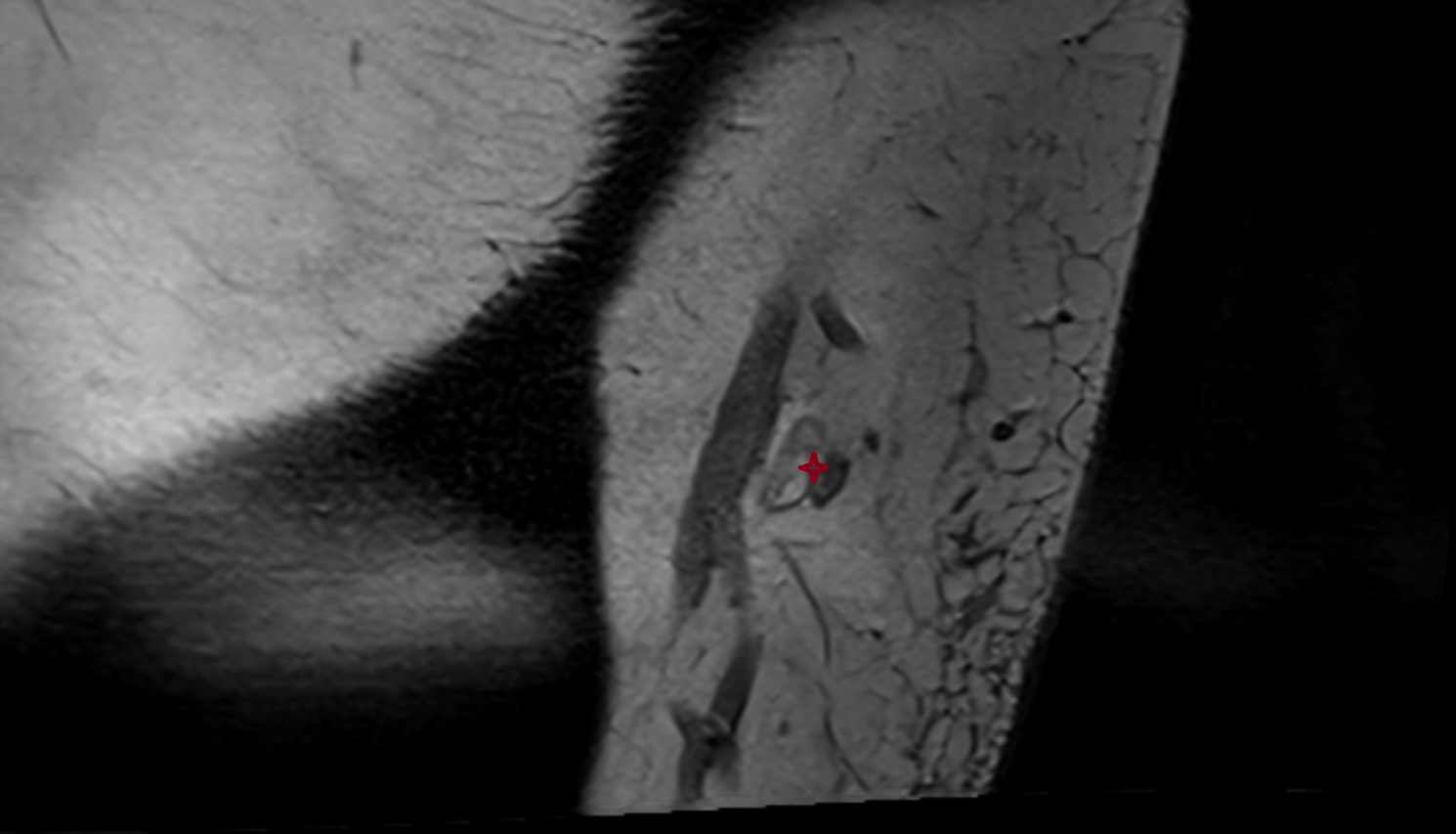 Supratrochlear lymph nodes sag cross sectional anatomy 3T MRI AI enhanced radiology image -img-00000-00000