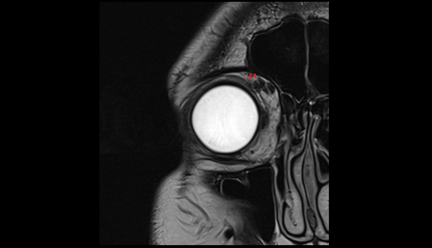 Supratrochlear nerve mri image