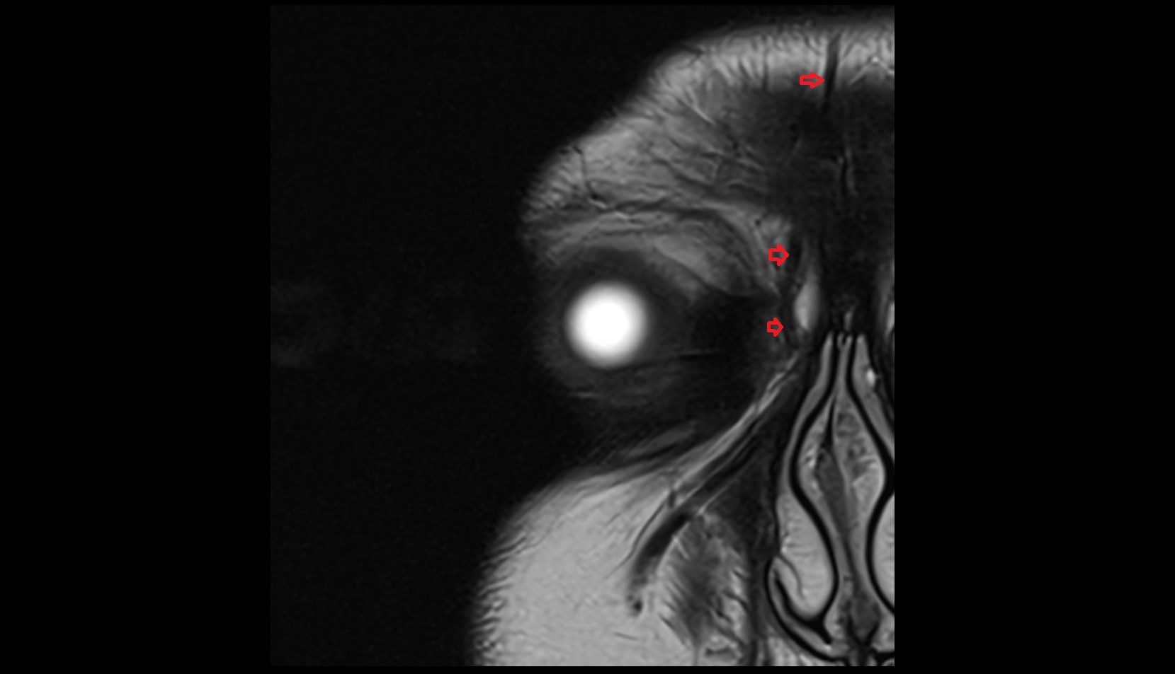 Supratrochlear vein mri image