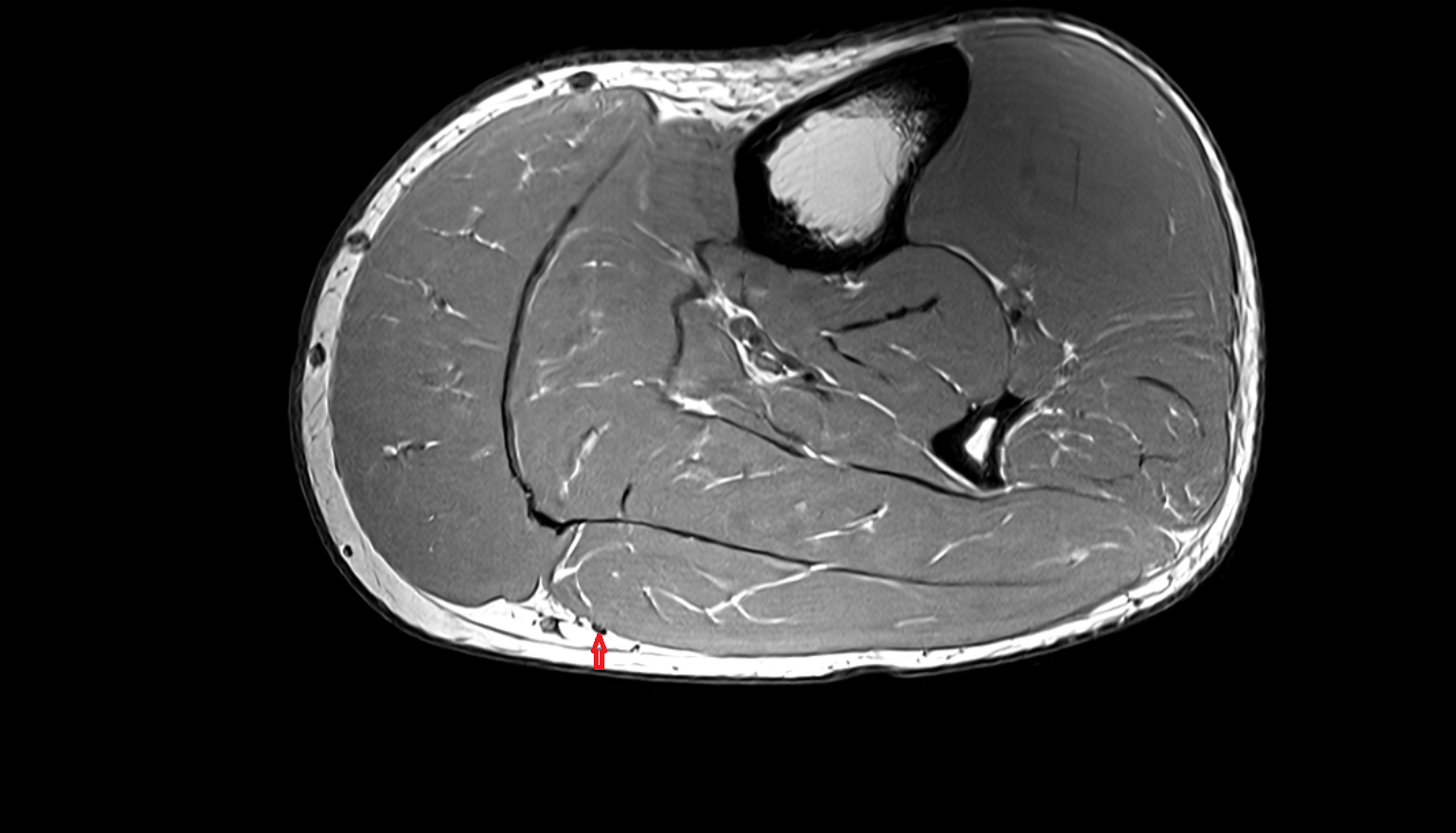 Sural nerve axial cross sectional anatomy 3T MRI AI enhanced radiology image-img-00000-00000