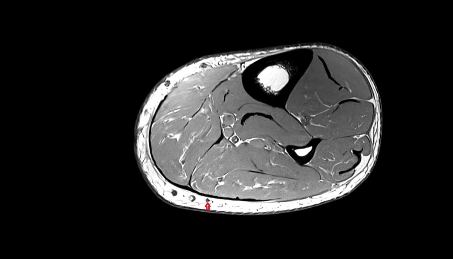 Sural nerve axial cross sectional anatomy 3T MRI AI enhanced radiology image-img-00000-00000_00001