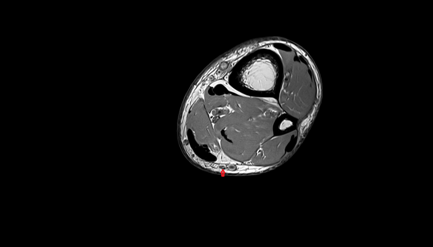 Sural nerve axial cross sectional anatomy 3T MRI AI enhanced radiology image-img-00000-00000_00002