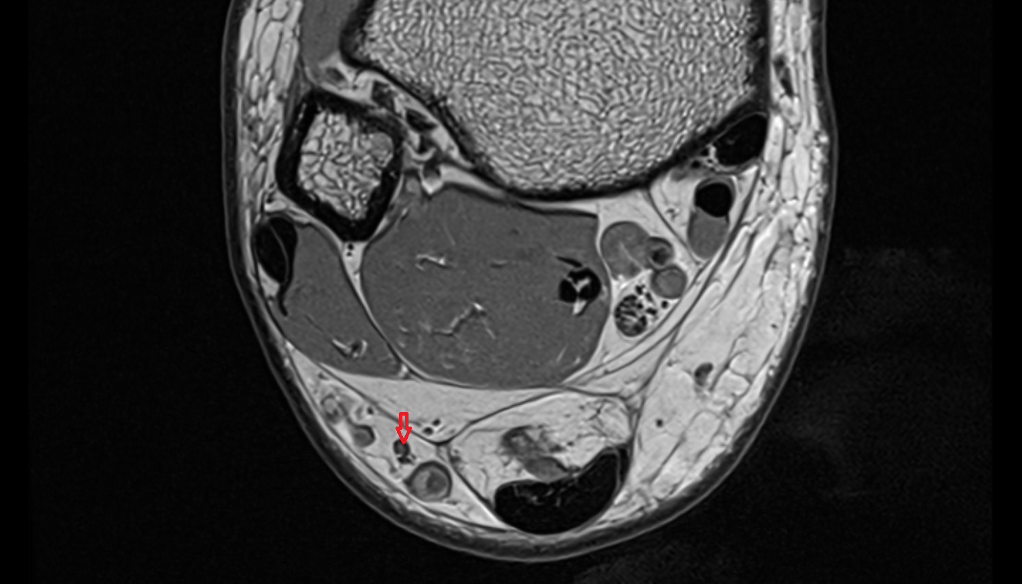 Sural nerve axial cross sectional anatomy 3T MRI AI enhanced radiology image-img-00000-00000_00003