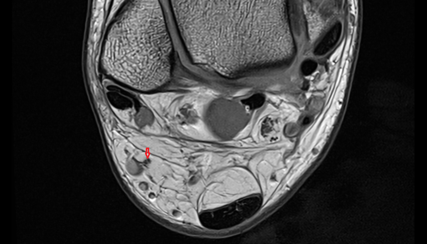 Sural nerve axial cross sectional anatomy 3T MRI AI enhanced radiology image-img-00000-00000_00004