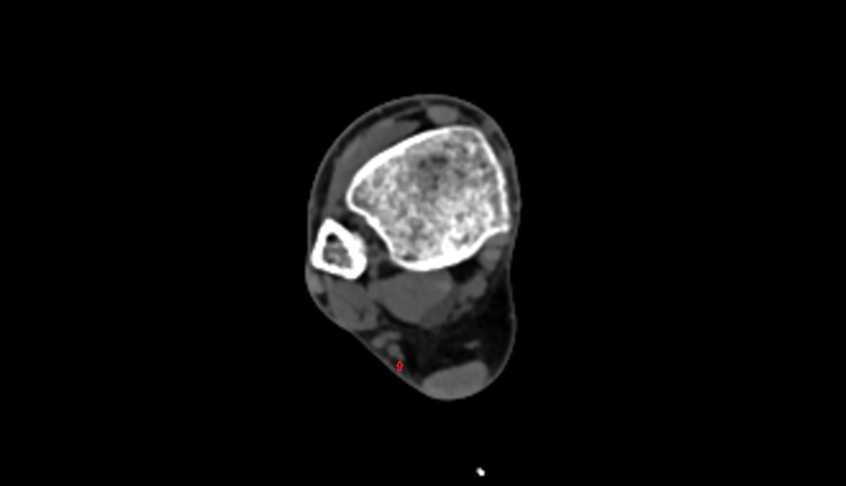 Sural nerve ct axial