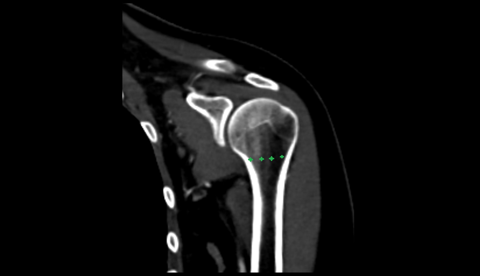 Surgical neck of humerus ct coronal image