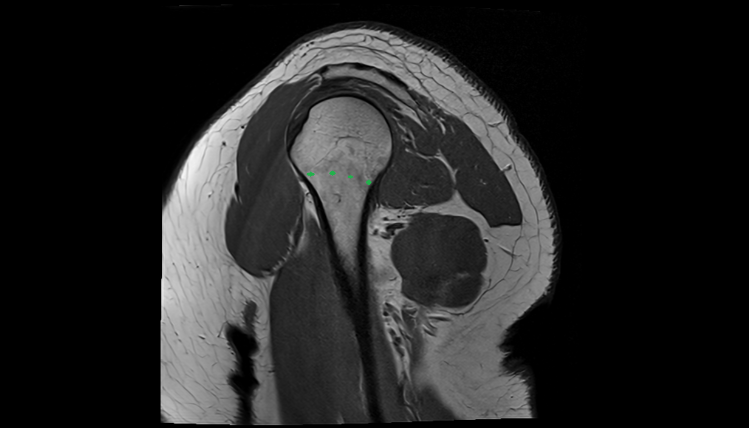 Surgical neck of humerus  sag cross sectional anatomy 3T MRI AI enhanced radiology image-img-00000-00000