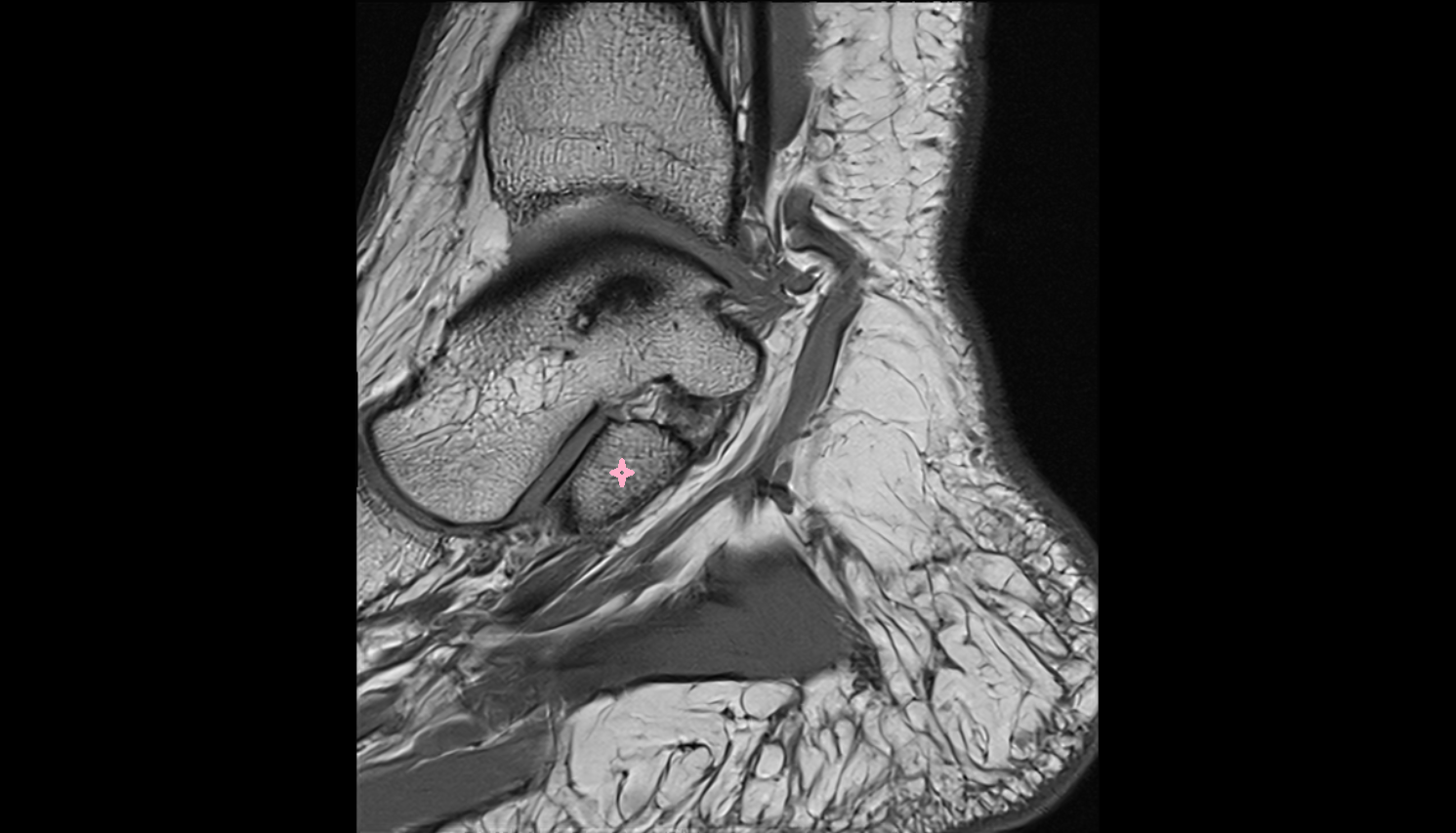 Sustentaculum tali MRI sagittal  cross sectional anatomy 3T MRI AI enhanced radiology image-img-00000-00000