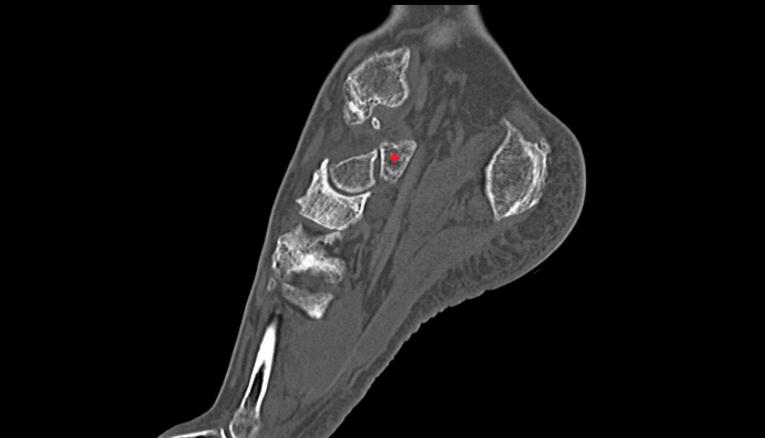 Sustentaculum tali   sagittal  CT cross sectional anatomy radiology image-img-00000-00000