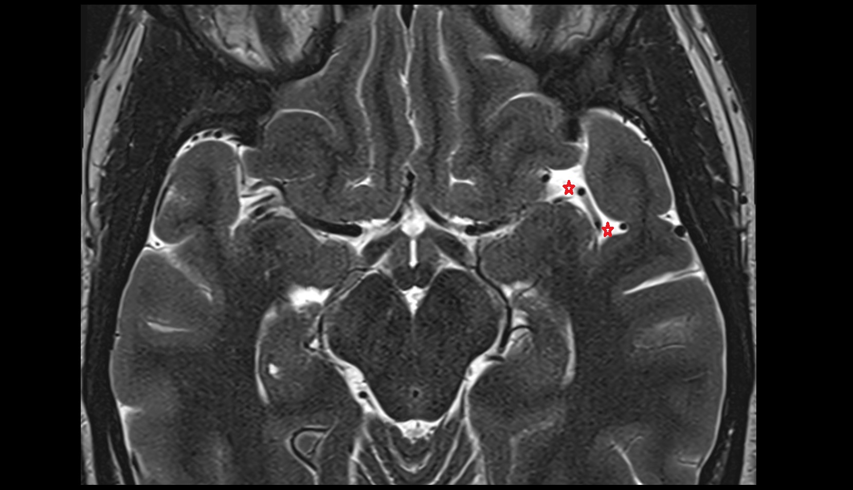 Sylvian cistern mri axial iamge