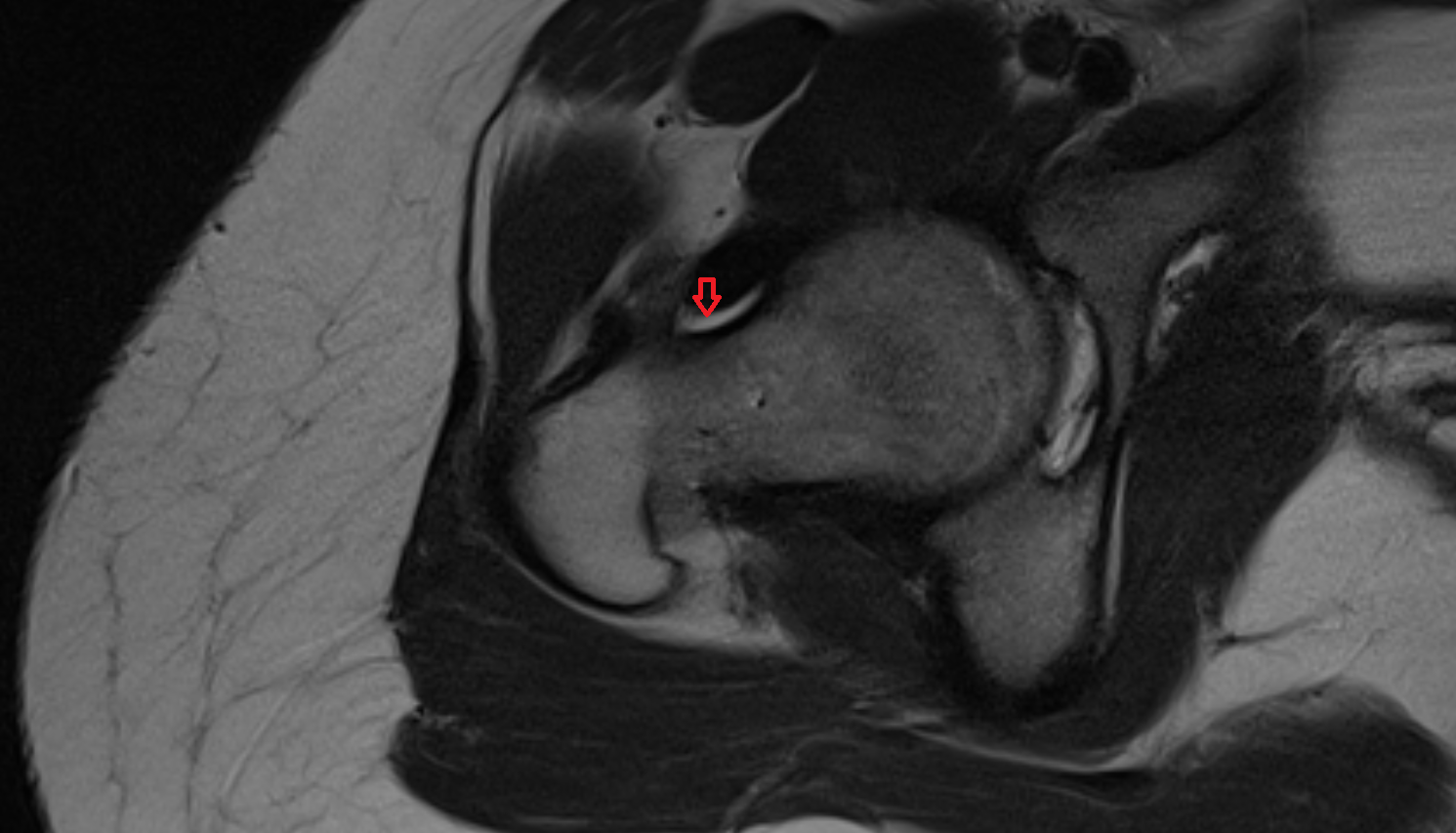 Synovial fluid AXIAL cross sectional anatomy 3T MRI AI enhanced radiology image-img-00000-00000