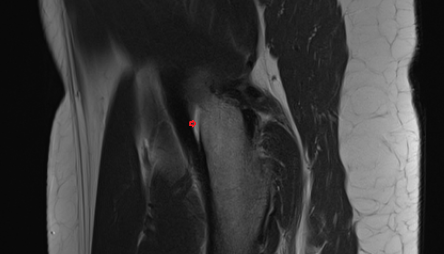 Synovial fluid AXIAL cross sectional anatomy 3T MRI AI enhanced radiology image-img-00000-00000_00001