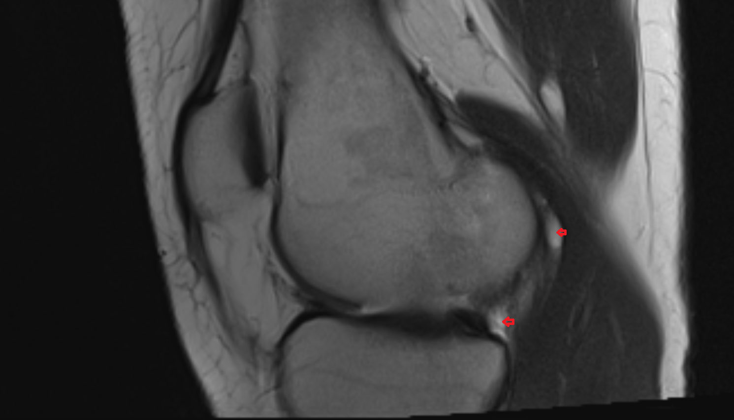 Synovial fluid AXIAL cross sectional anatomy 3T MRI AI enhanced radiology image-img-00000-00000_00002