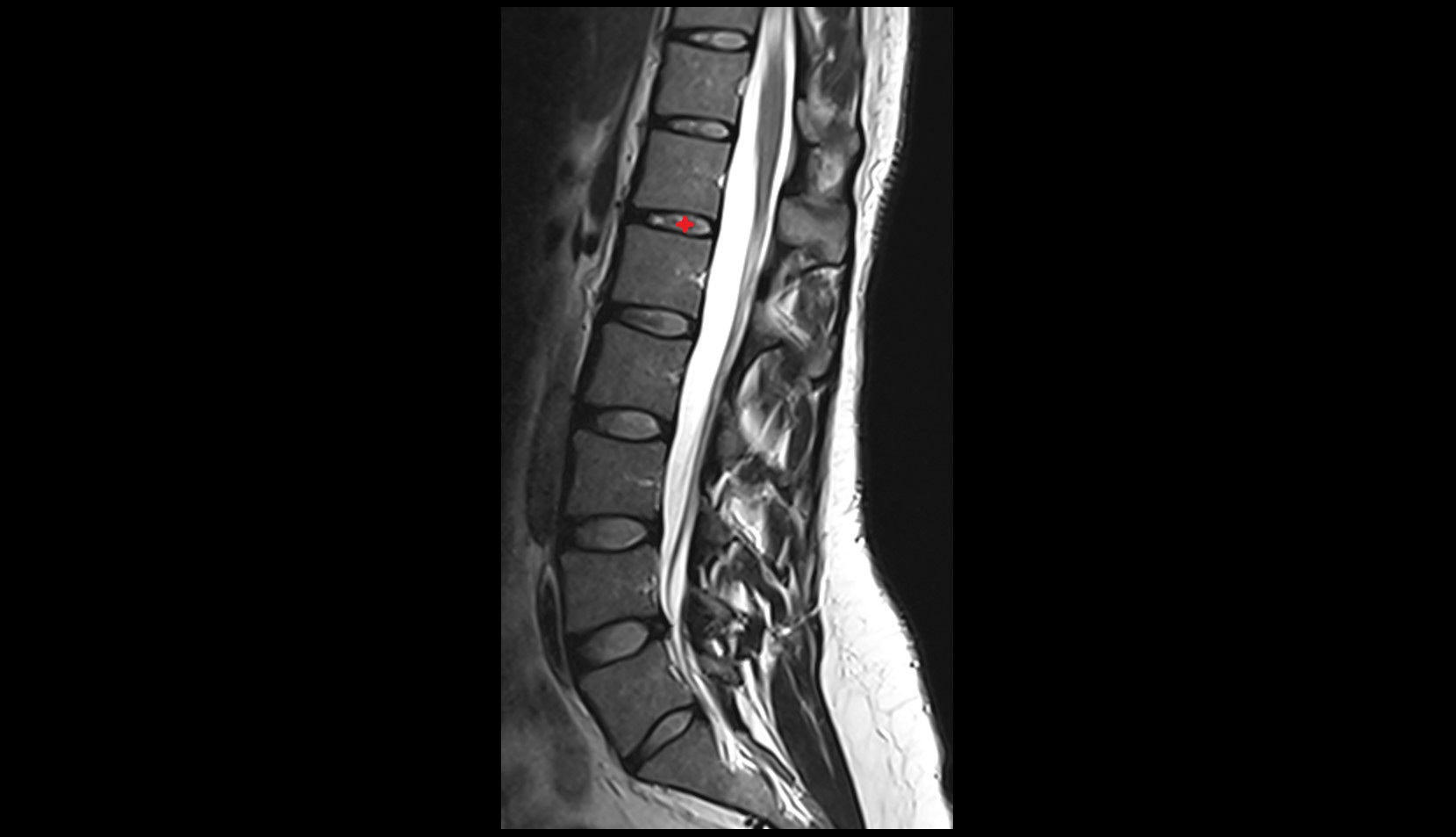 T12-L1  Intervertebral Disc mri anatomy  image
